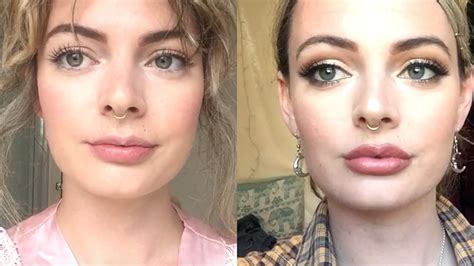 05ml Lip Fillers Before And After One Week Vlog 💉 Youtube
