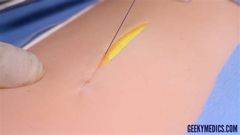 Subcuticular Suture Osce Guide Surgical Skills Geeky Medics