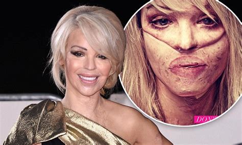 Katie Piper Reveals How Proud She Is To Have Survived Acid Attack