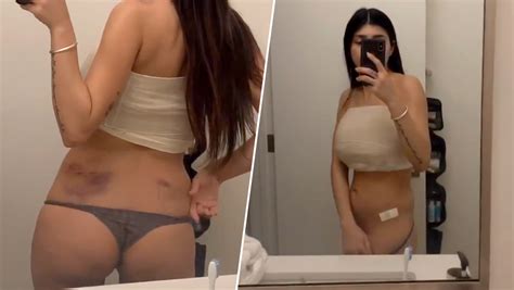 Mia Khalifa Shares Glimpse Of Her Recovery After Ice Hockey Puck