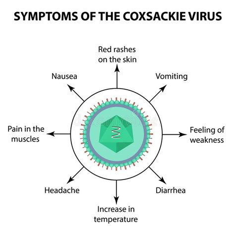 Síntomas Del Virus De Coxsackie De La Infección Ilustración Del Vector