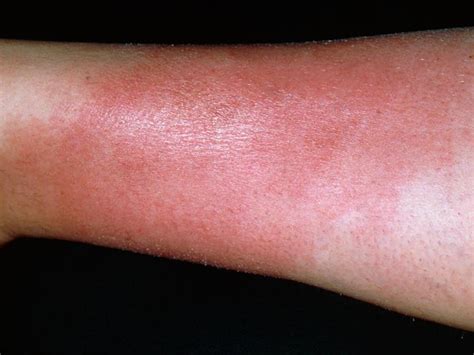 What You Need To Know About Cellulitis Now To Love