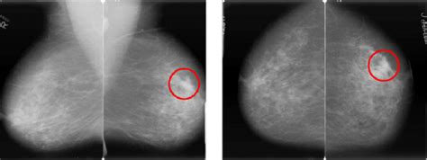A Mlo And B Cc Views Of A Right And Left Breast Of A Patient The