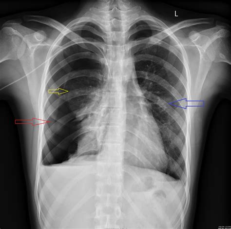 This leads to a loss of negative pressure between the two pleural membranes, which can result in the part. Cureus | Simultaneous Bilateral Spontaneous Pneumothorax ...