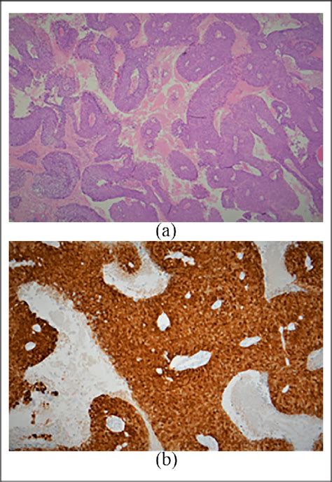 Figure 2 From Cutaneous Hpv16 And P16 Positive Basaloid Squamous Cell
