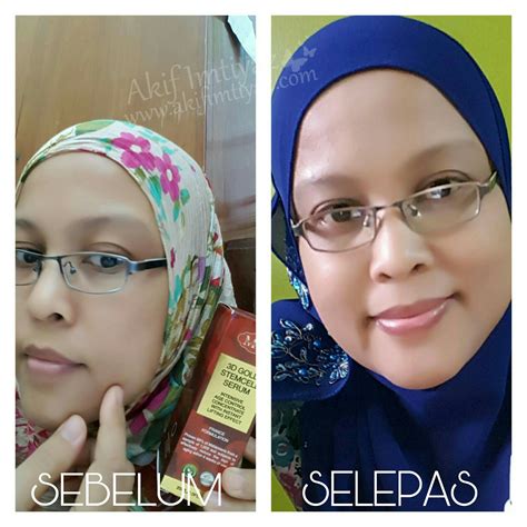 Sebab kurang tidur + letih kan. Kulit Wajah Flawless Hanya Dengan 3D Gold Stemcell Serum ...