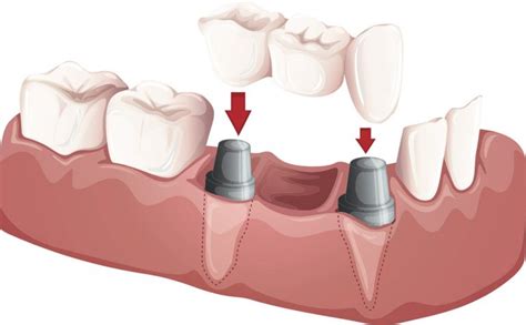 Dental Crowns Tooth Bridges Pacific Oral Surgery