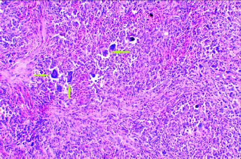 In Case Of The Diffuse Type Of Tenosynovial Giant Cell Tumor