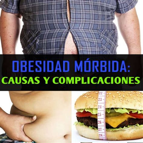 Obesidad Mórbida Causas Síntomas Y Complicaciones La Guía De Las