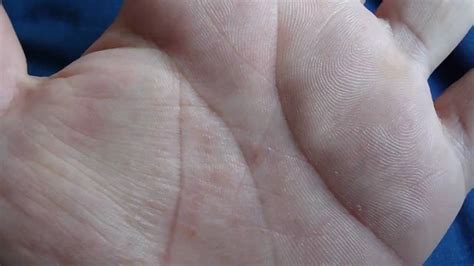 Itchy Patch Of Skin On Hand Mapssupernal