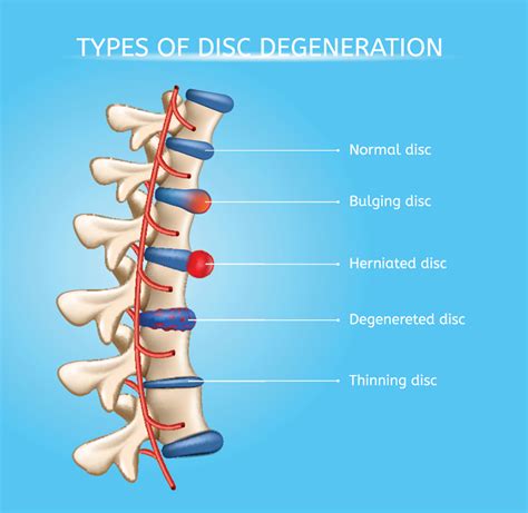 Lumbar Spine Bulging Disc Vs Herniated Disc Mri Bulging Disc Vs