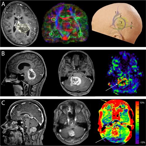 Frontiers Advanced Intraoperative Mri In Pediatric Brain Tumor Surgery