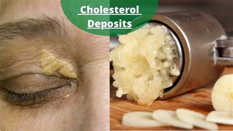 How To Remove The Cholesterol Deposits Around Your Eyes Natural