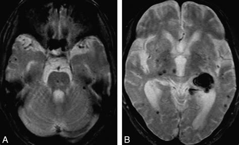 Association Between Cerebral Microbleeds On T2 Weighted Mr Images And
