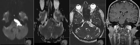 Epidermoid Cyst