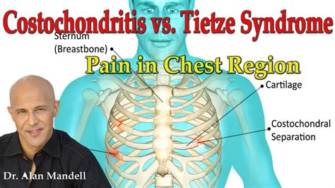 Costochondritis Vs Tietzes Syndrome Pain In Chest Region Dr