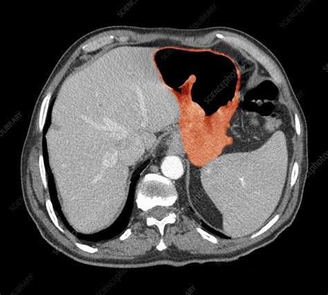 Stomach Cancer Ct Scan Stock Image C0213036 Science Photo Library