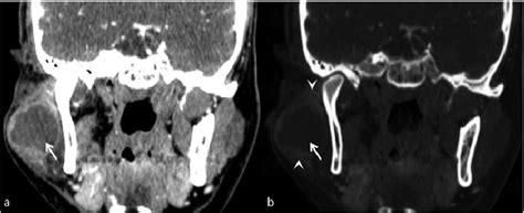 Large Parotid Abscess A The Coronal Contrastenhanced Ct Image Shows