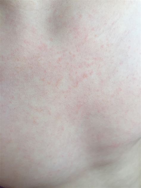 Skin Concern Hello I Noticed These Tiny Bumps Over My Childs Chest