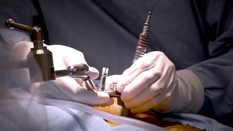 Minimally Invasive Laminectomy Surgery To Treat Lumbar Stenosis Medstar Southern Maryland
