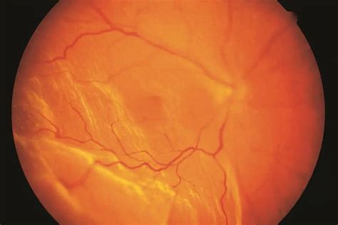 Retinal Detachment American Academy Of Ophthalmology