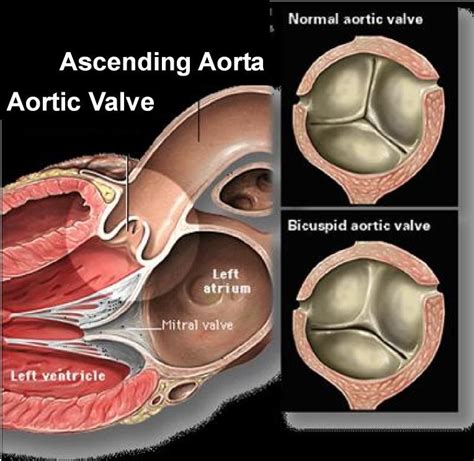 Bisucspid Aortic Valve Bav Disease Bicuspid Aortic Valve Aortic