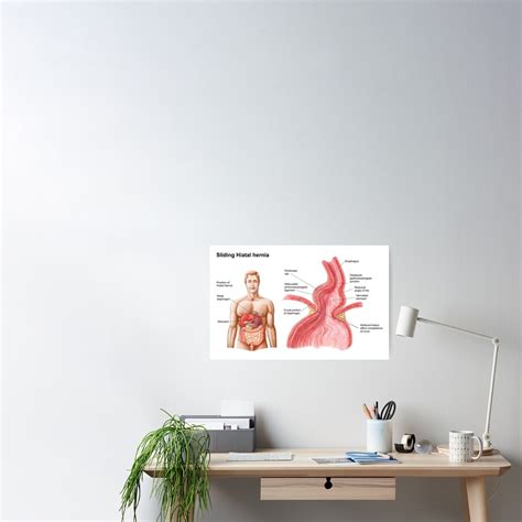 Medical Illustration Of A Hiatal Hernia In The Upper Part Of The