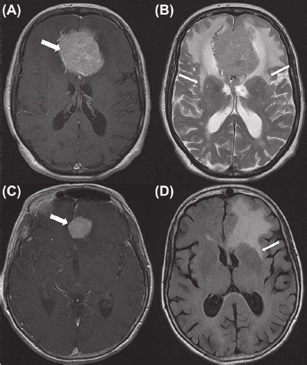 A B Axial T1 Weighted Mri Post Gadolinium Contrast A And