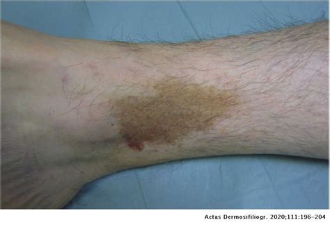 Pigmented Purpuric Dermatosis A Review Of The Literature Actas Dermo
