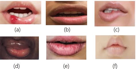 Different Disorders In Lip A D Medical Condition Affecting Texture