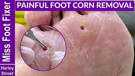 Satisfying Deep Corns Removal With Callus Youtube