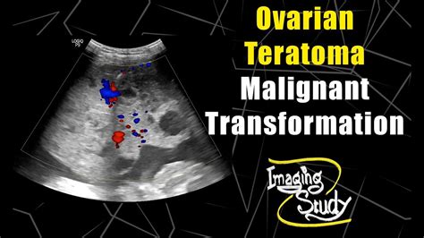 Ovarian Immature Teratoma Ultrasound Doppler Case 78 Youtube