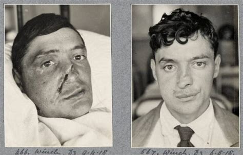 25 Incredible Before And After Photos Of Disfigured Ww1 Soldiers Who