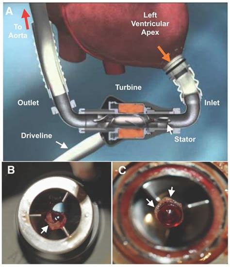 Diagnosis Of Lvad Thrombus Using A High Avidity Fibrin Specific 99mtc Probe