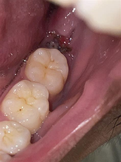 Does This Look Like Food Is Stuck In The Extraction Of The Wisdom Teeth