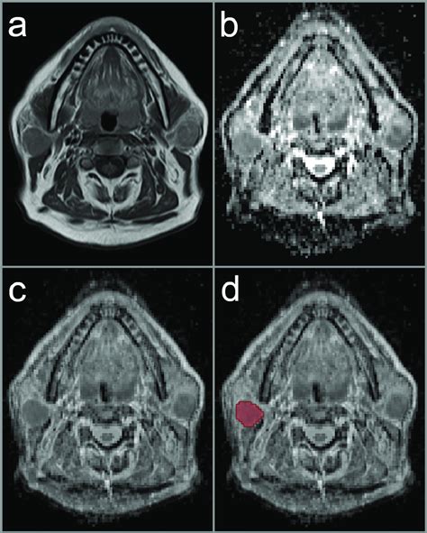 Image Illustrating A Study Patient With Bilateral Warthin Tumors Red