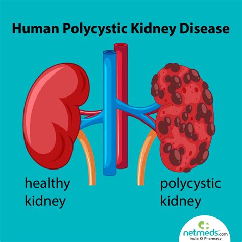 Polycystic Kidney Disease Pictures