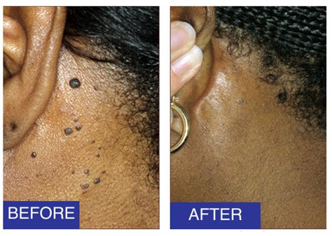Dermatosis Papulosa Nigra Removal Before And After