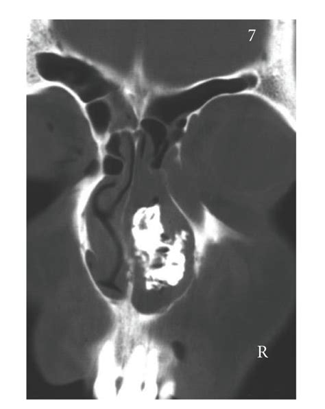 Coronal Ct Showing A Calcified Space Consuming Lesion Occupying Much Of
