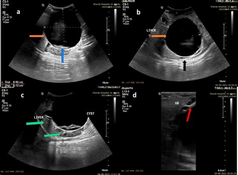 Ab Ultrasound Of The Abdomen In A 4 Month Male Infant Revealed A
