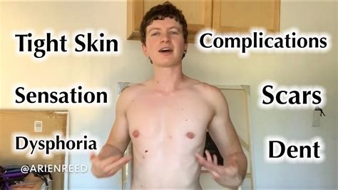 Ftm Top Surgery Update Months Keyhole Peri Areola With English Closed Captions And Alt