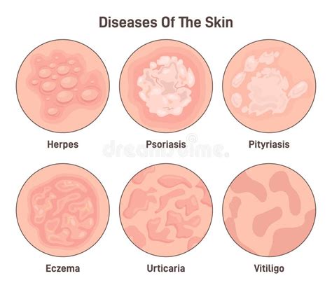 Malattie Della Pelle Dermatite Eczema E Psoriasi Dermatologia