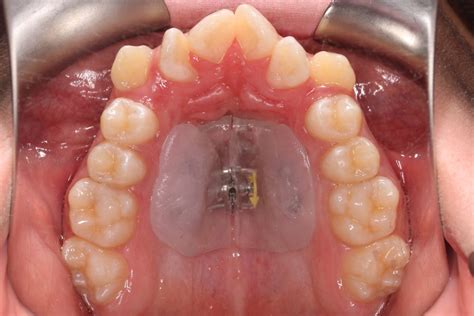 Palatal Expanders Why How And When