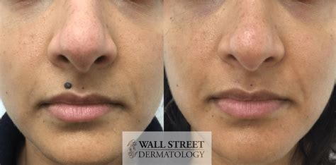 Mole Removal Nyc Wall Street Dermatology