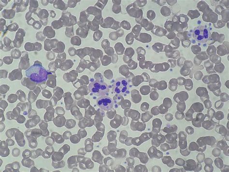 Platelet Abnormalities Hematology