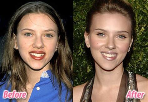 Stars Before And After Plastic Surgery Pics Izismile Com