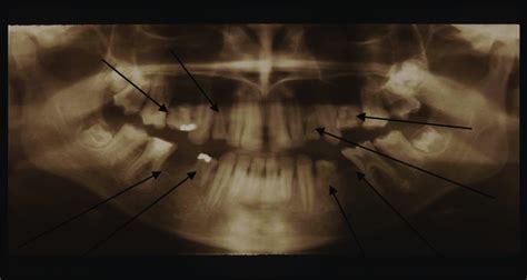 Dpt Showing Various Over Retained Deciduous Teeth And Edentulous
