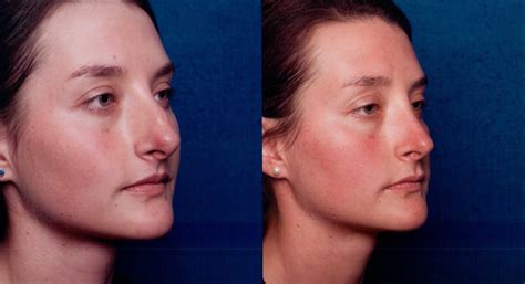 The Nose Clinic BEFORE AFTER NOSE SURGERY PHOTOS 57