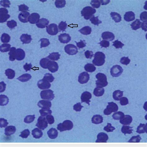 Peripheral Blood Smear Of A Patient Showing The Presence Of Multiple
