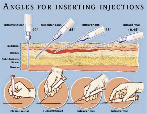 Iv Drug Injection Sites